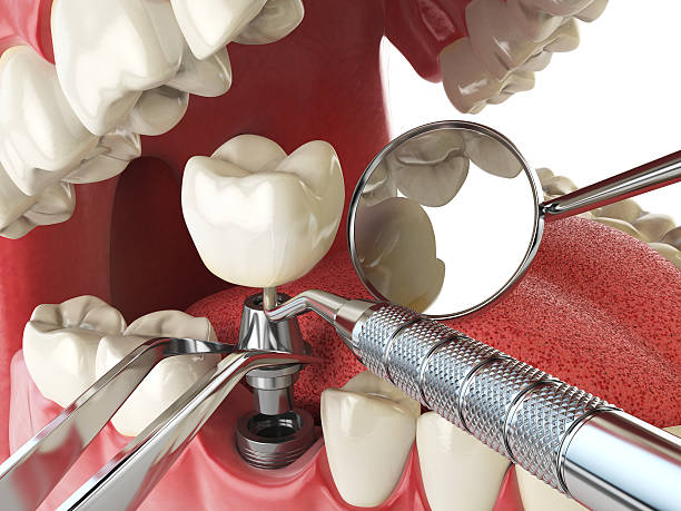 Best Emergency Dental Care for Broken or Chipped Teeth in Chula Vista, CA